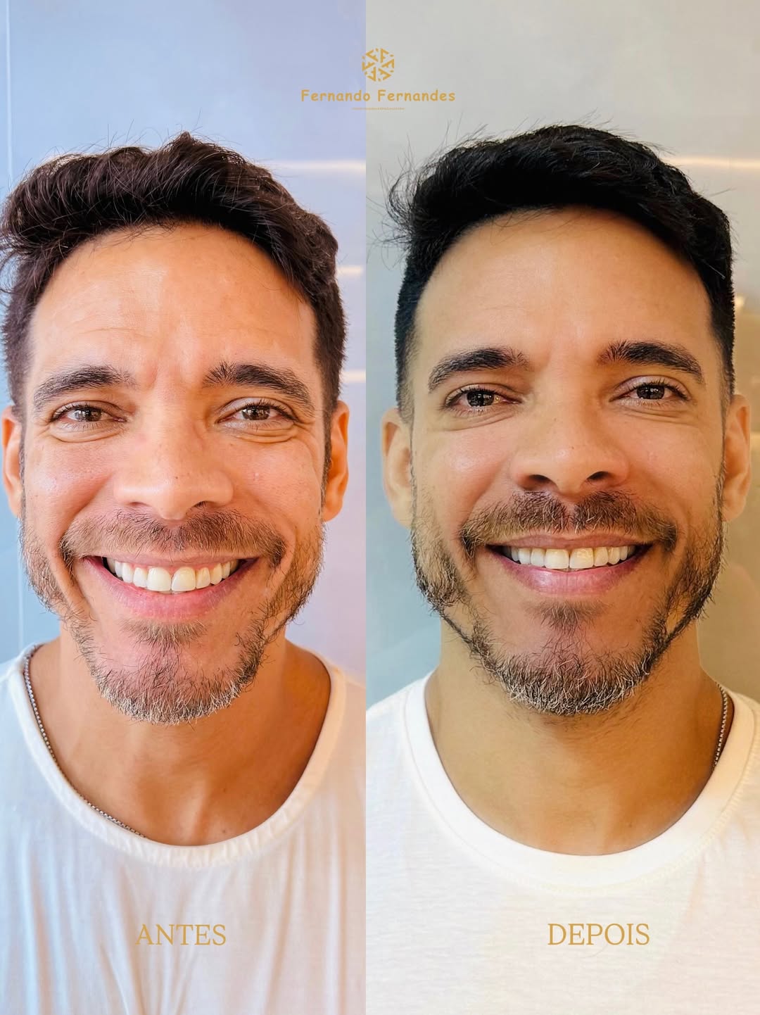Resultado Harmonização Facial — Antes e Depois